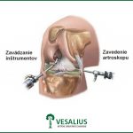 Artroskopia kolena - pohľad zvnútra