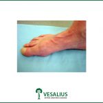 Hallux rigidus