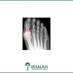 RTG obraz hallux rigidus